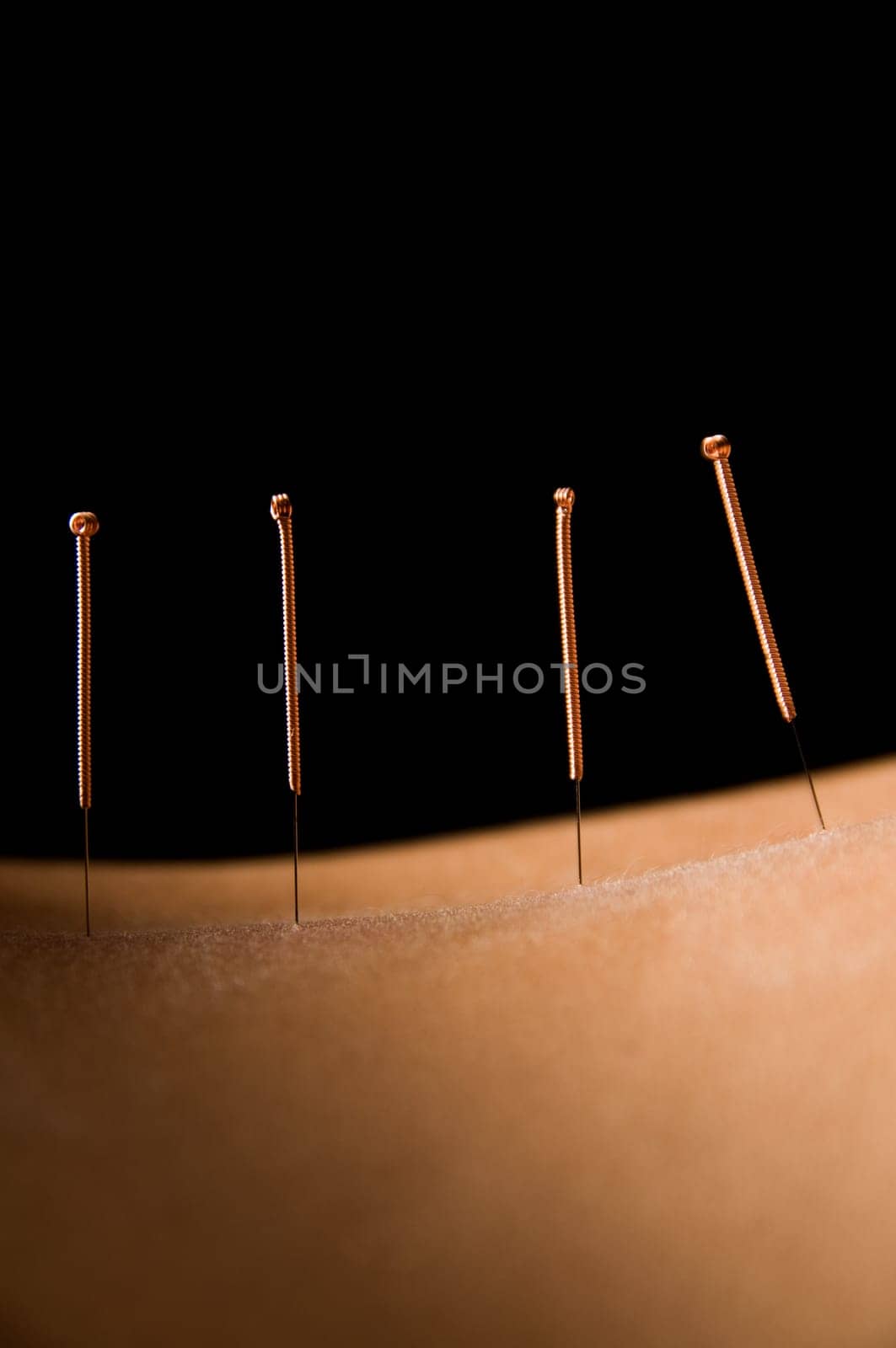 Woman getting an acupuncture treatment in a spa