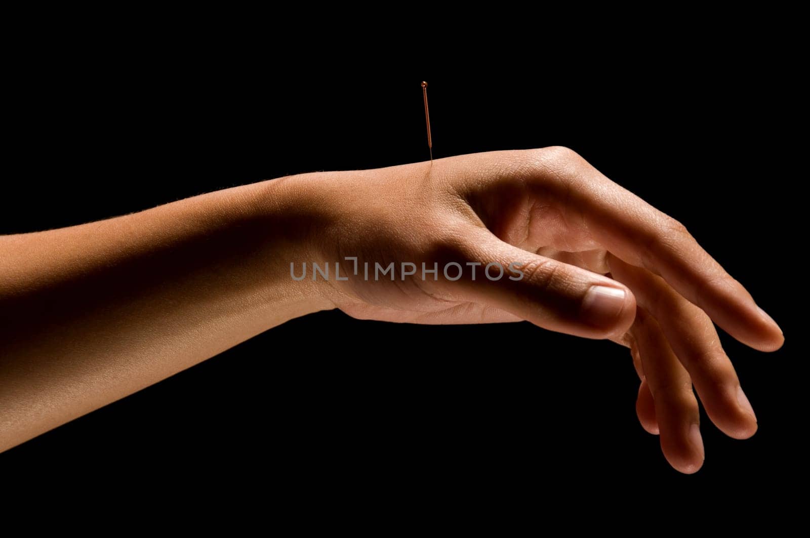 Woman getting an acupuncture treatment in a spa