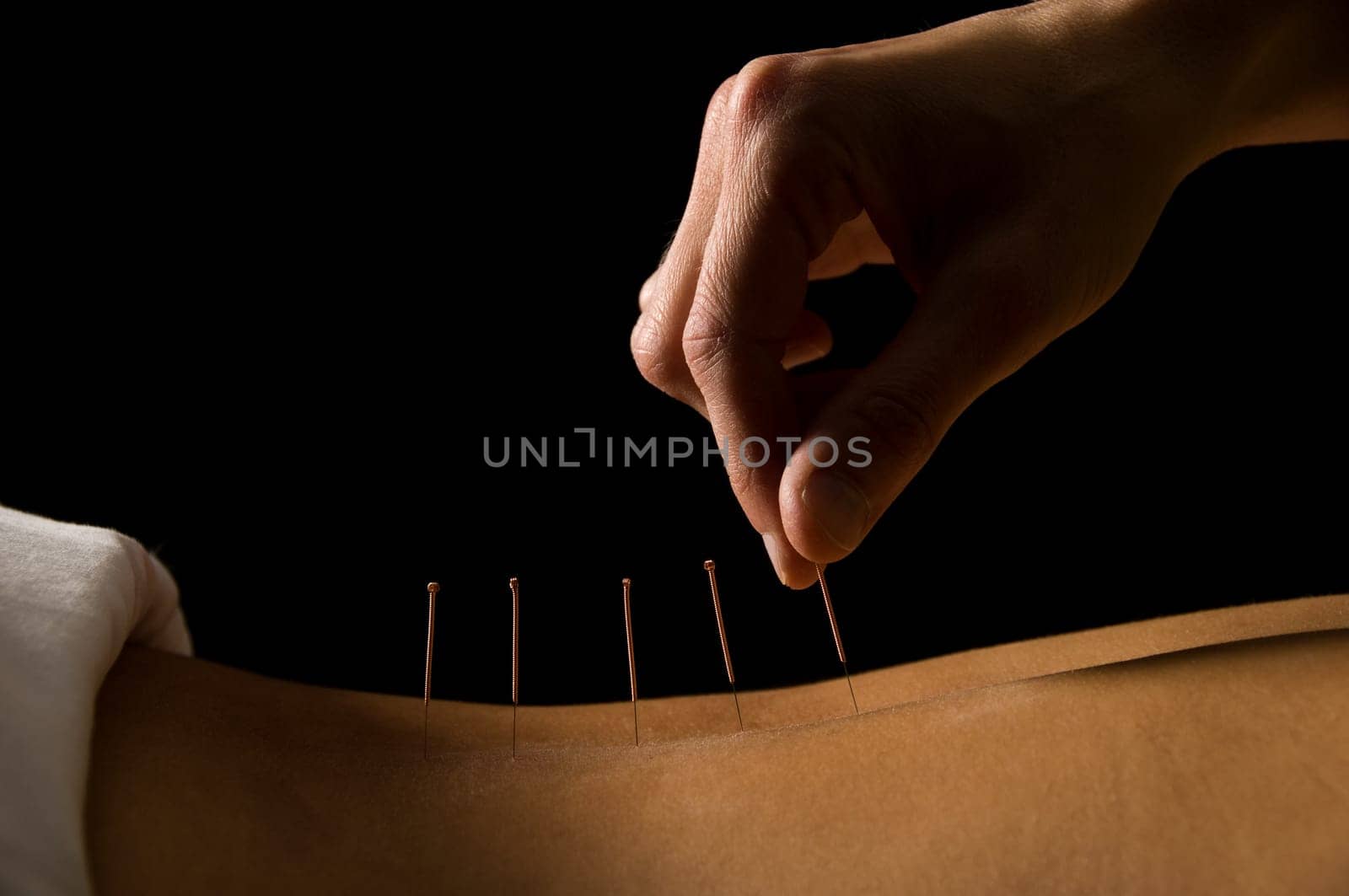 Woman getting an acupuncture treatment in a spa