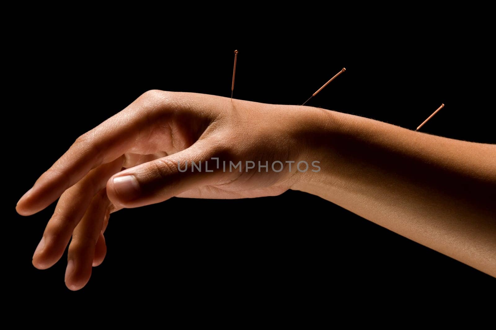 Woman getting an acupuncture treatment in a spa