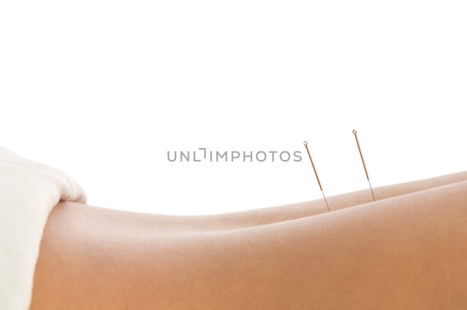 Woman getting an acupuncture treatment in a spa