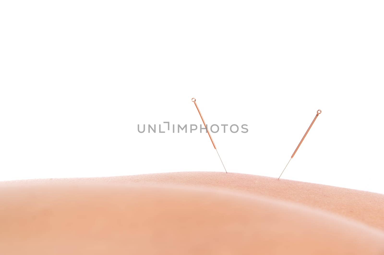 Woman getting an acupuncture treatment in a spa