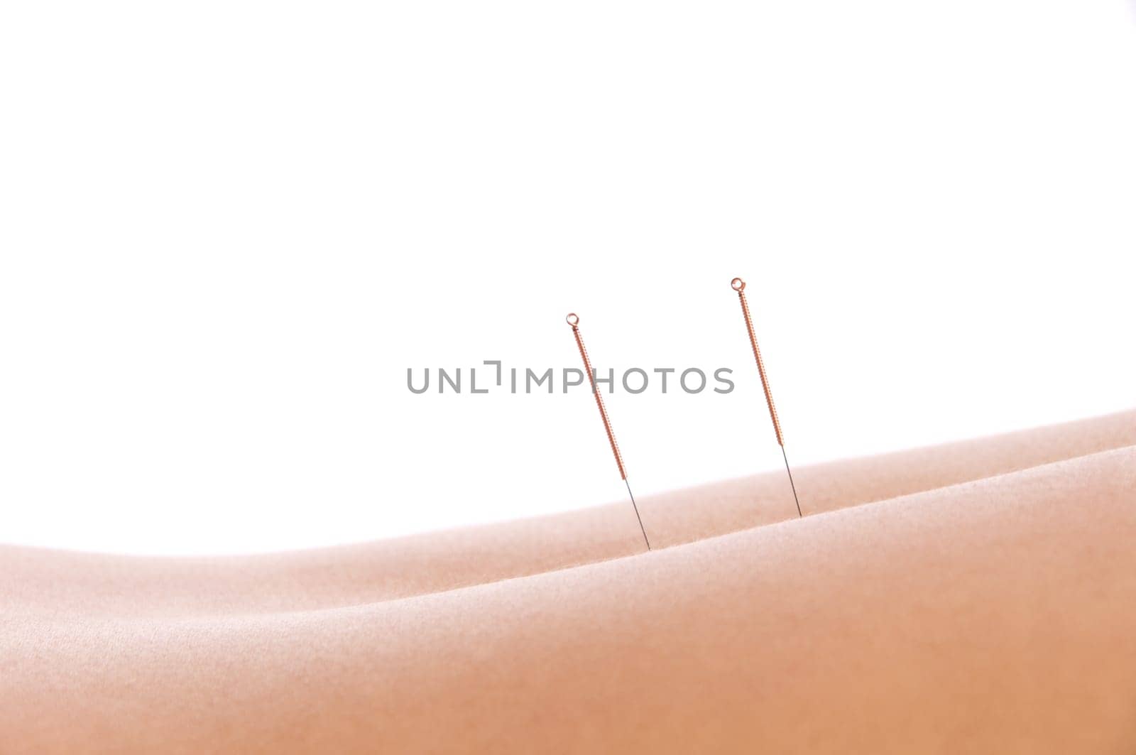 Woman getting an acupuncture treatment in a spa