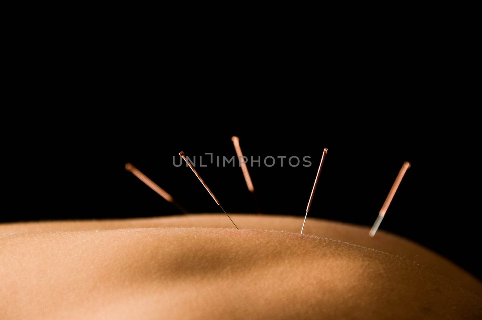 Woman getting an acupuncture treatment in a spa