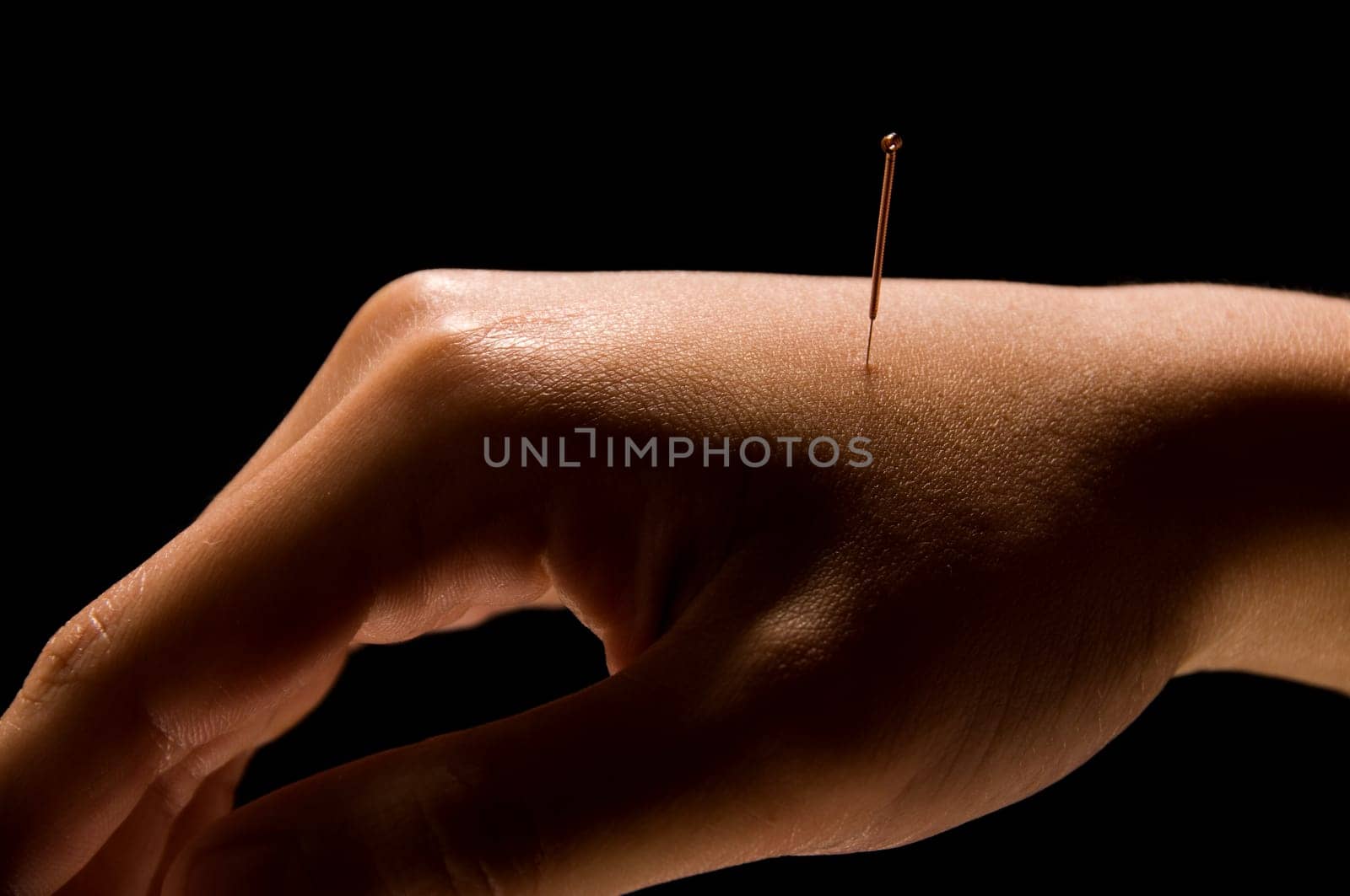 Woman getting an acupuncture treatment in a spa