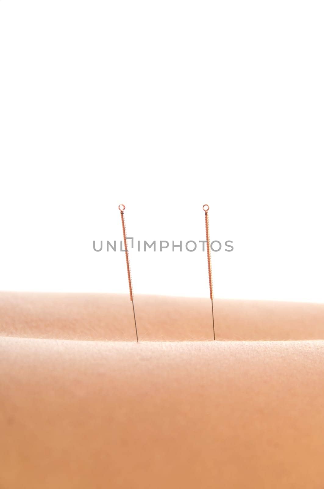 Woman getting an acupuncture treatment in a spa