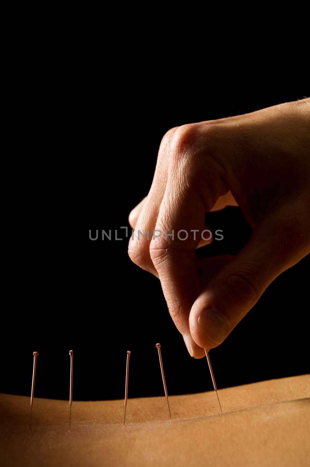 Woman getting an acupuncture treatment in a spa