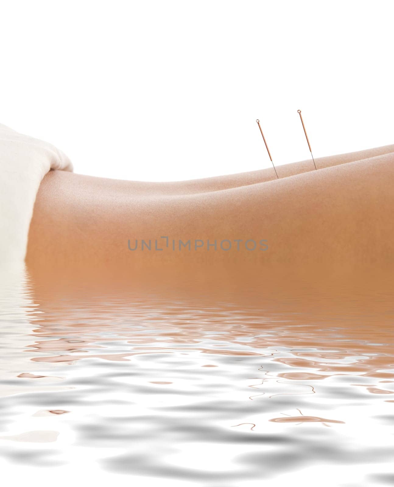 Woman getting an acupuncture treatment in a spa