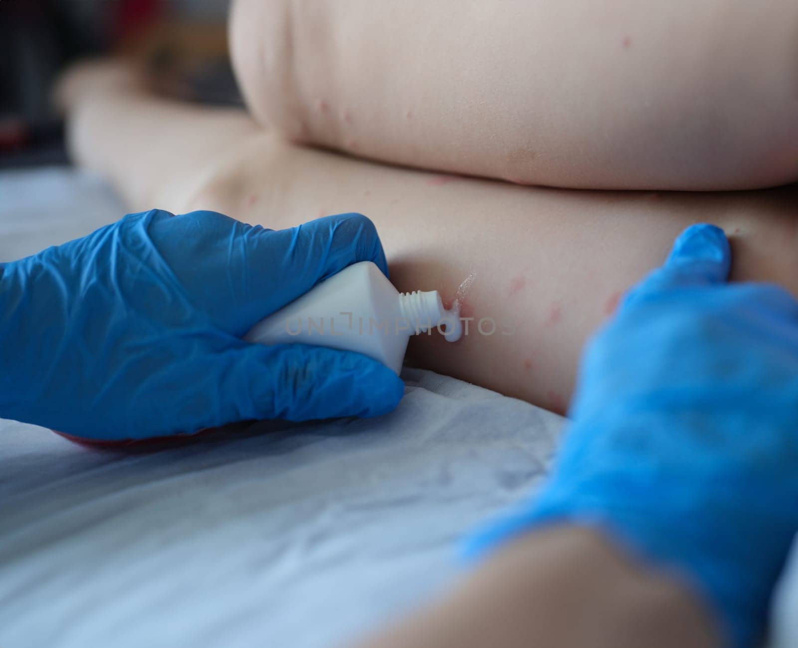 Gloved doctor applies cream to the skin of patient with red itchy inflammations. Insect bites and child skin allergies concept