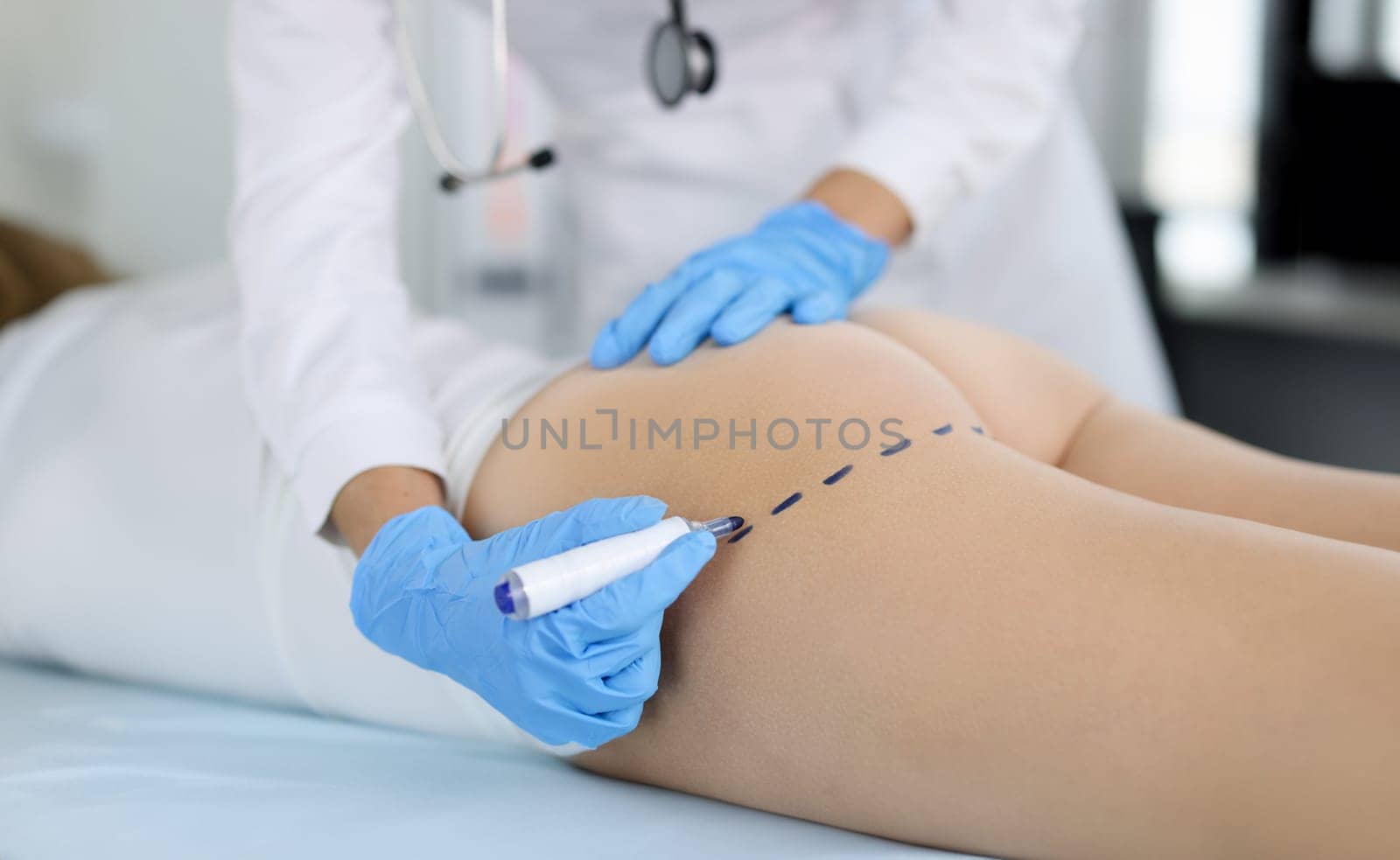 Doctor draws marks on the patient's buttocks with marker for body shaping. Buttocks plastic concept