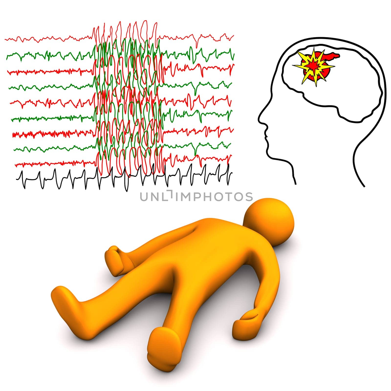 Orange cartoon character with apoplectic or epileptic stroke, on the white background.
