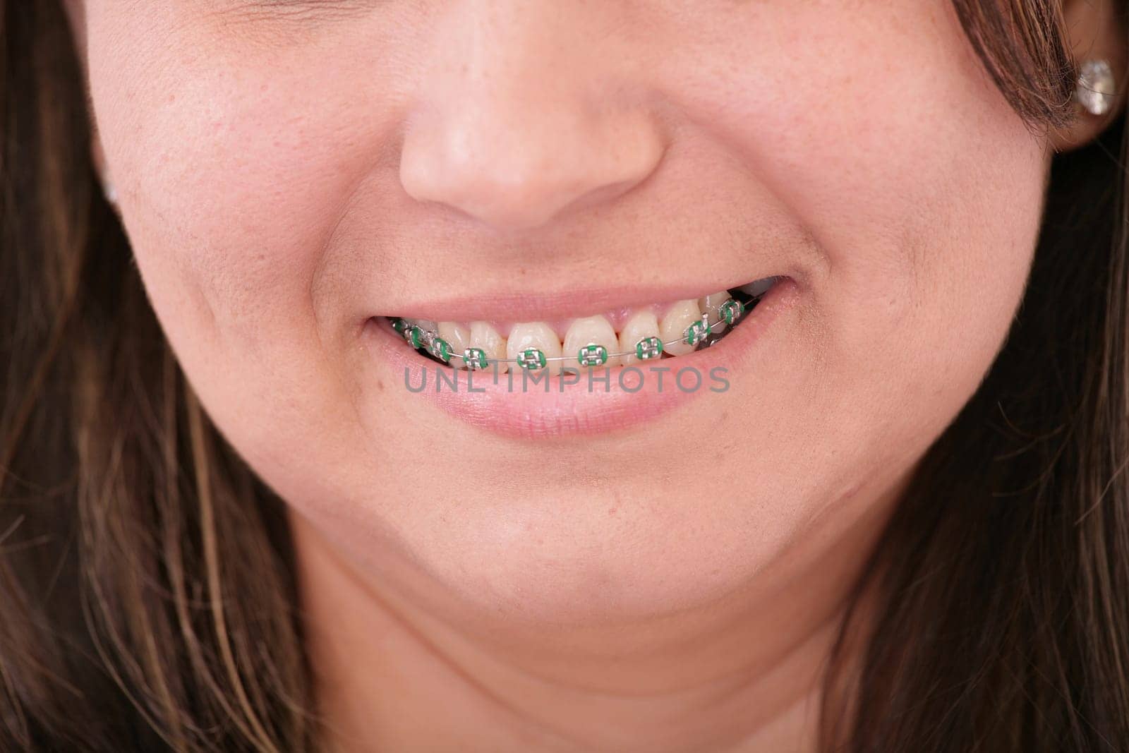 teeth with braces