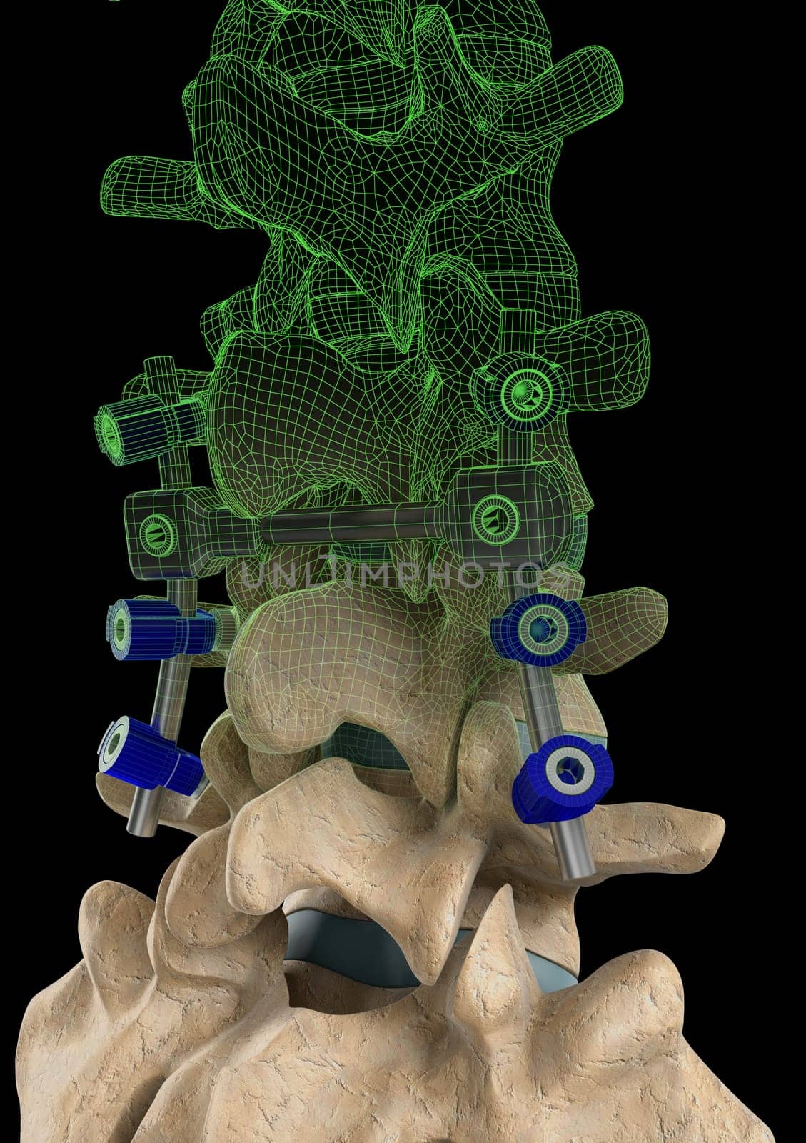 Rendering of a spine with a screw support system and a computer generated wire frame on a black background.