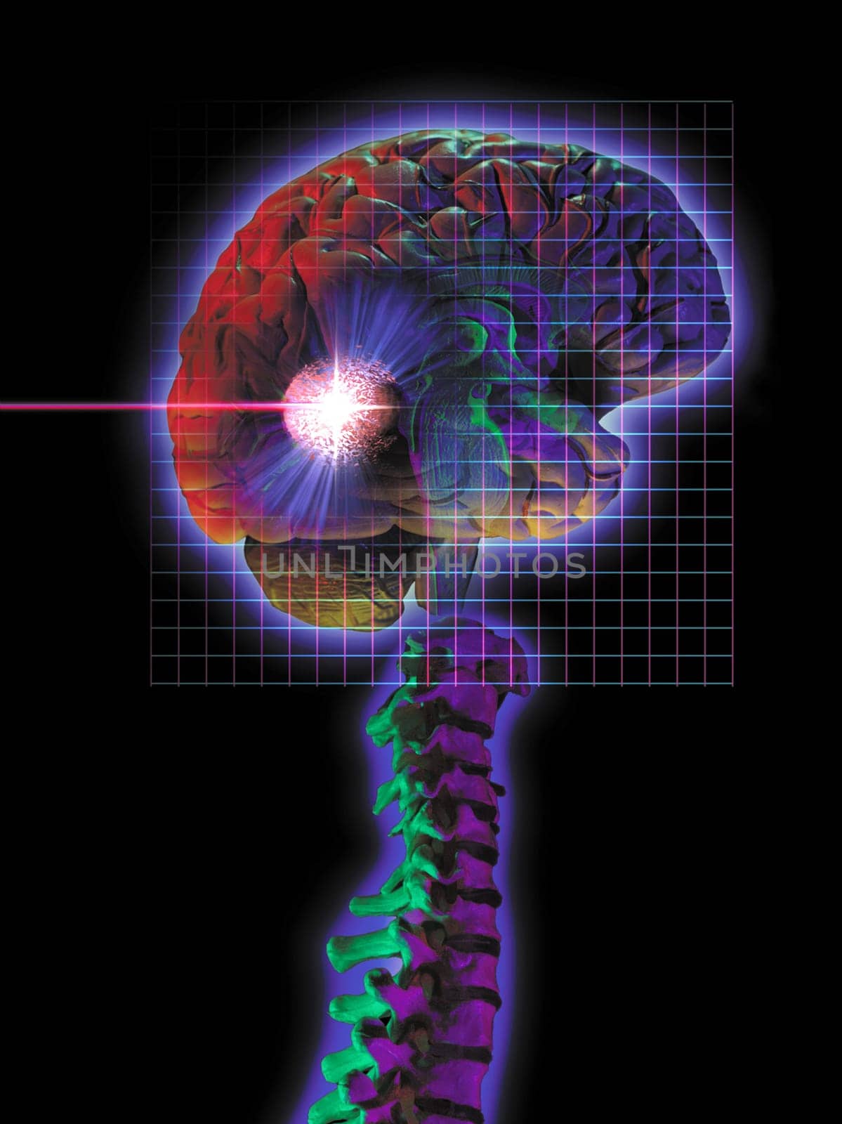 Diagram of Radiosurgery being performed.