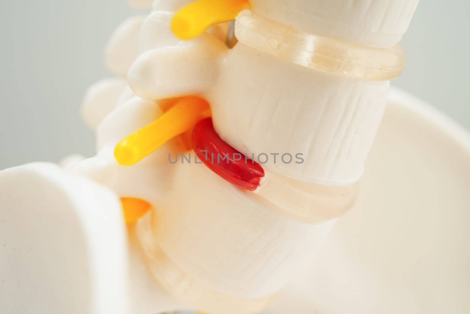 Spinal nerve and bone, Lumbar spine displaced herniated disc fragment, Model for treatment medical in the orthopedic department.