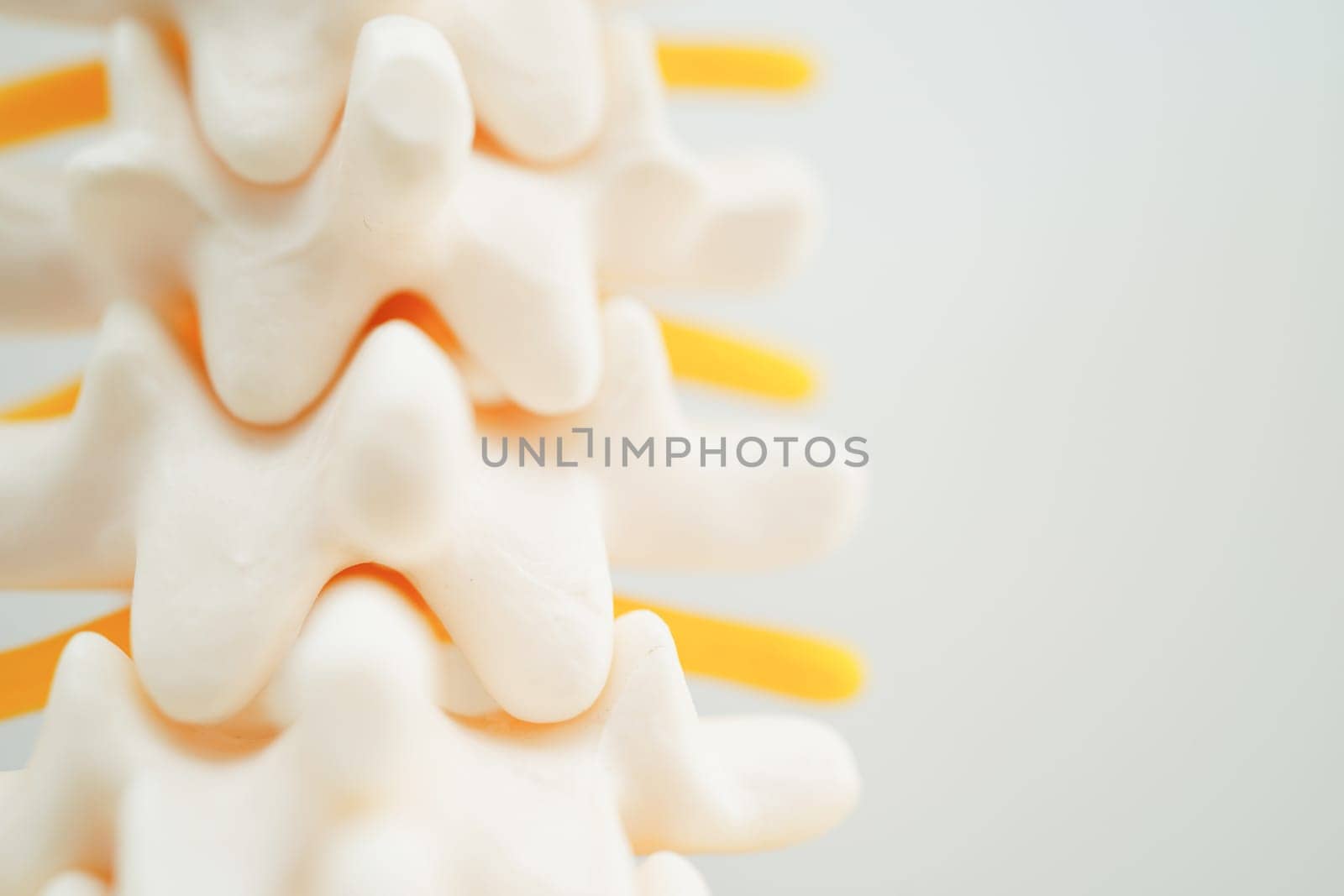 Spinal nerve and bone, Lumbar spine displaced herniated disc fragment, Model for treatment medical in the orthopedic department. by sweettomato