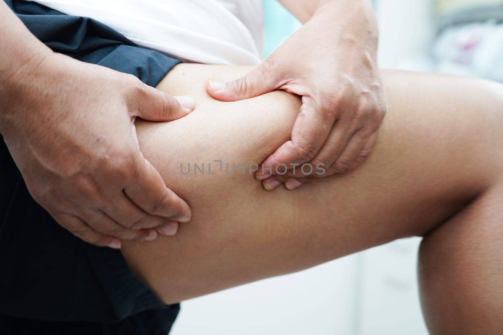 Asian woman with cellulite on leg skin fat, overweight problem. by sweettomato