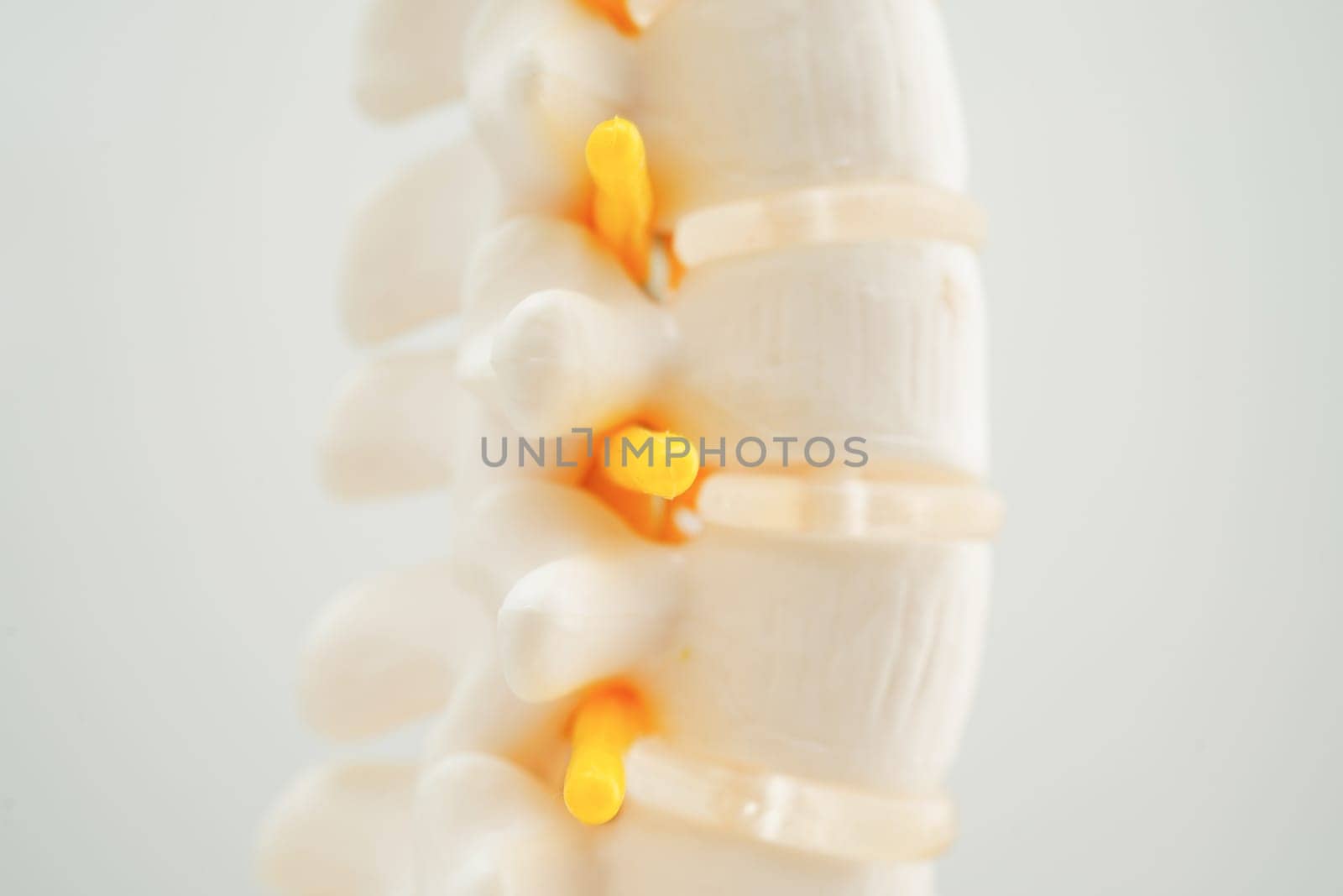 Spinal nerve and bone, Lumbar spine displaced herniated disc fragment, Model for treatment medical in the orthopedic department.
