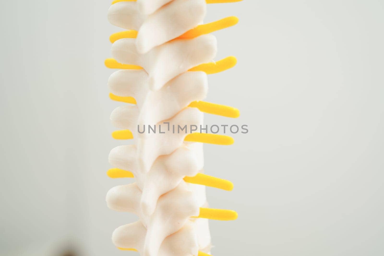 Spinal nerve and bone, Lumbar spine displaced herniated disc fragment, Model for treatment medical in the orthopedic department. by sweettomato