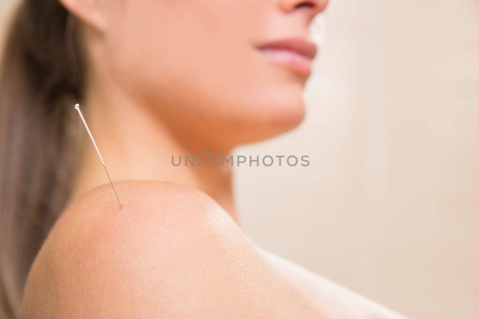 Acupuncture needle pricking on woman shoulder therapy closeup