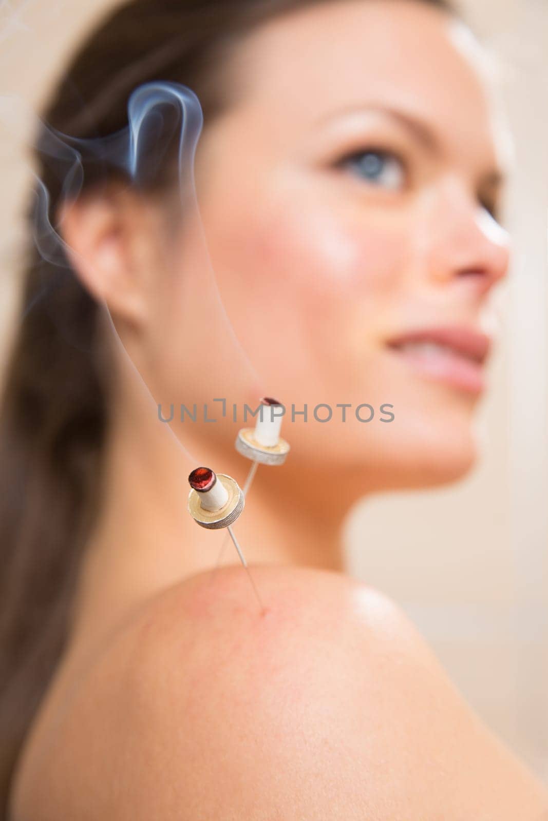 moxibustion acupunture needles heat on woman shoulder closeup