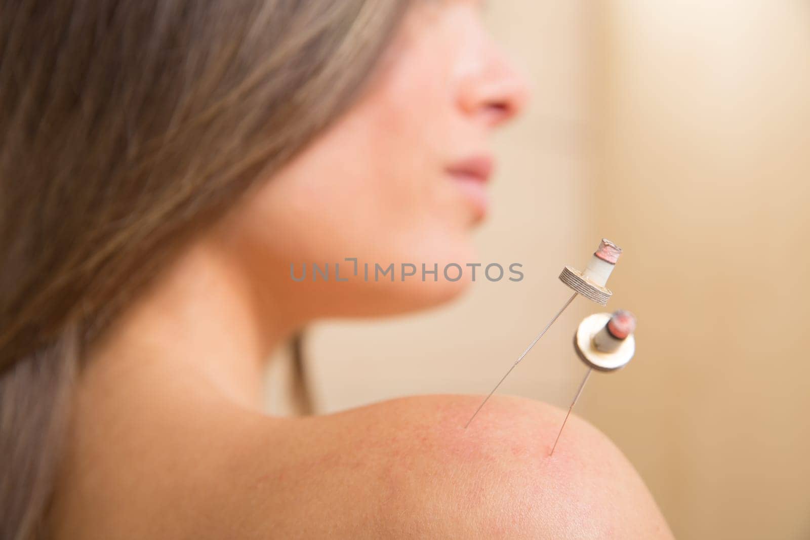 moxibustion acupunture needles heat on woman shoulder closeup
