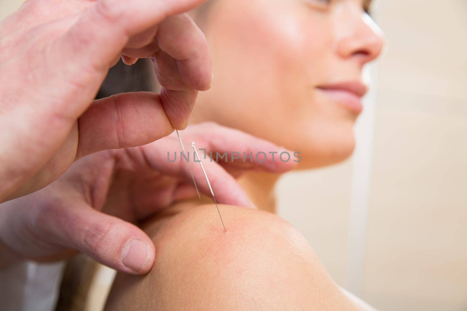 Doctor hands acupuncture needle pricking on woman patient closeup