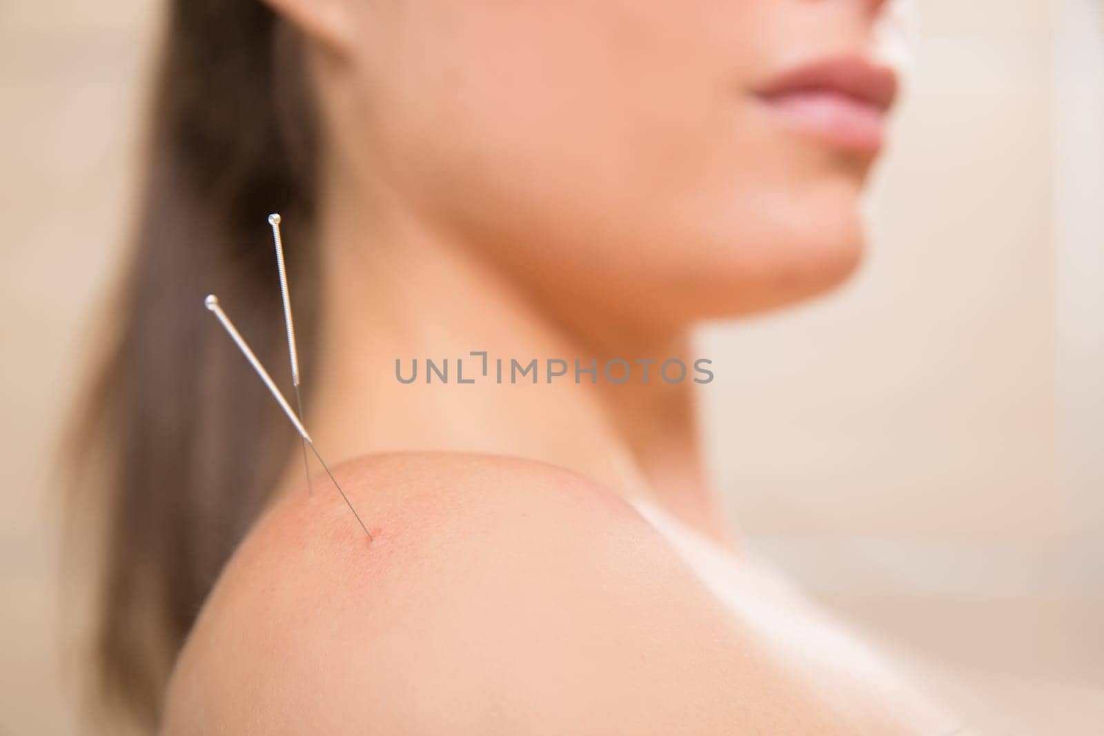 Acupuncture needle pricking on woman shoulder therapy closeup