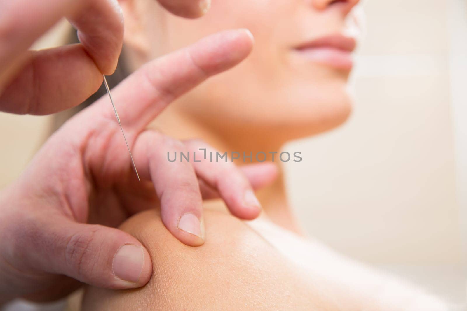 Doctor hands acupuncture needle pricking on woman patient closeup