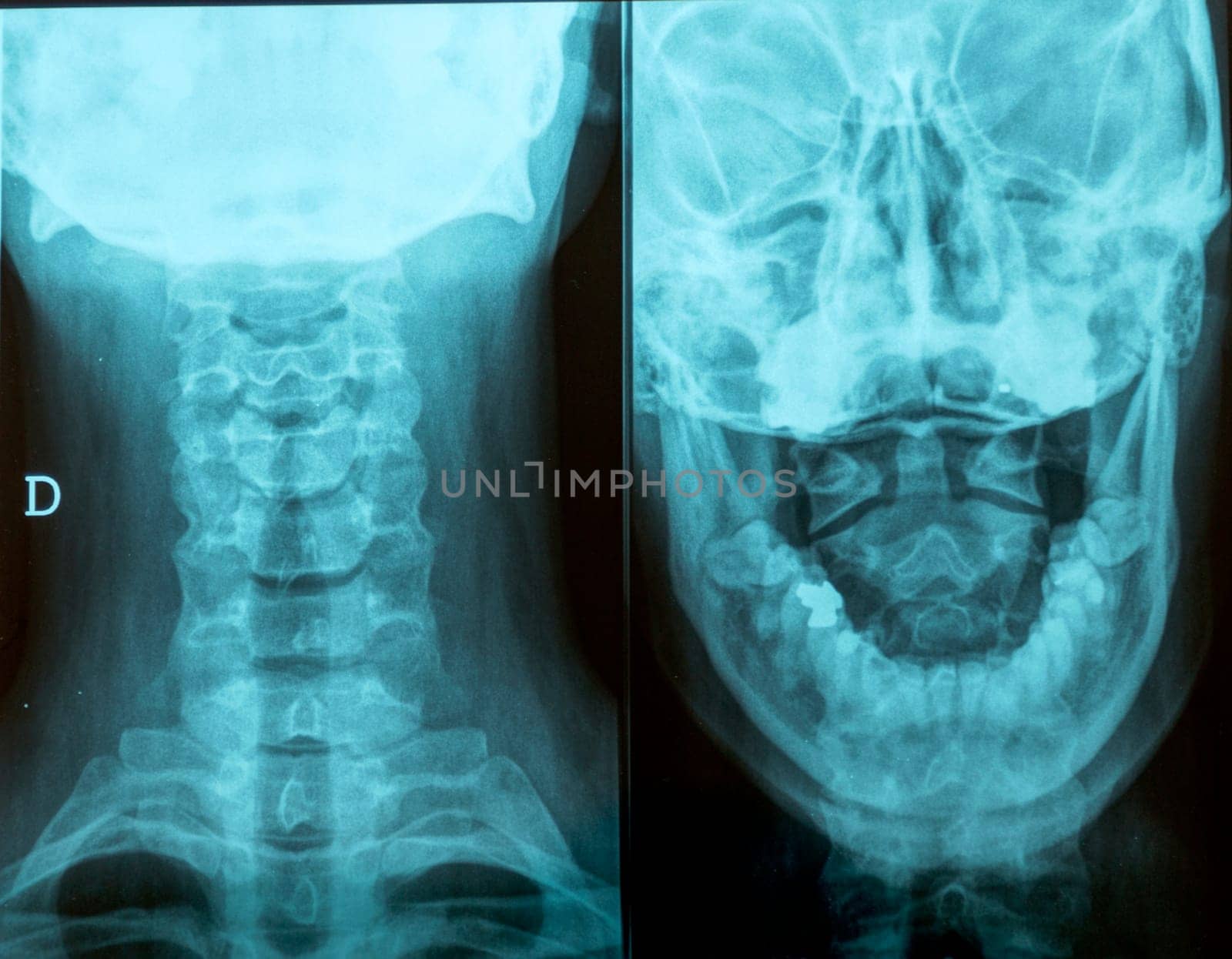 Radiography front and back of the head