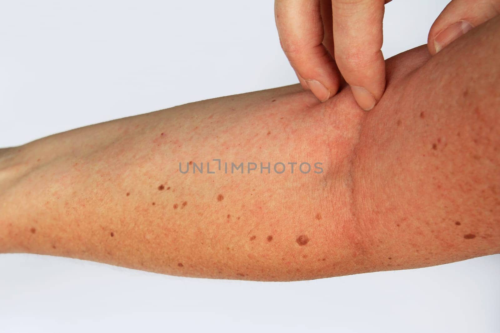 Itchy rash