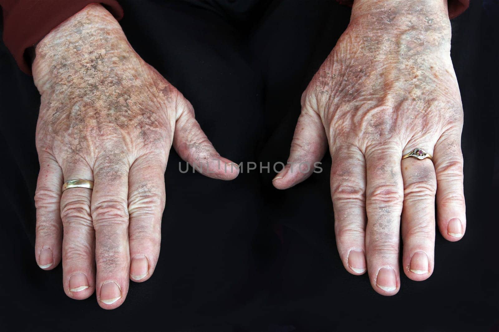 Psoriasis