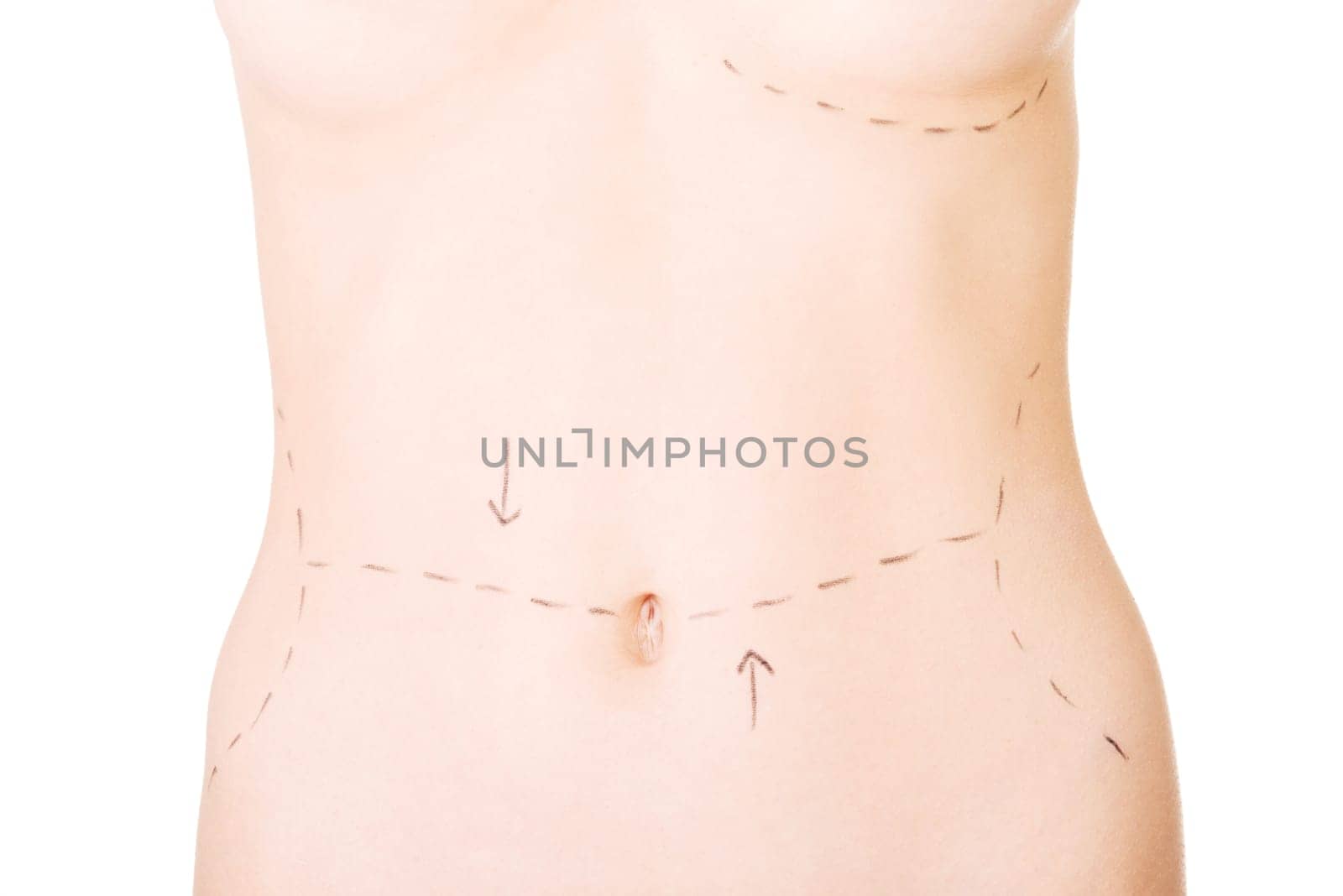 Woman belly marked out for cosmetic surgery. Isolated on white.