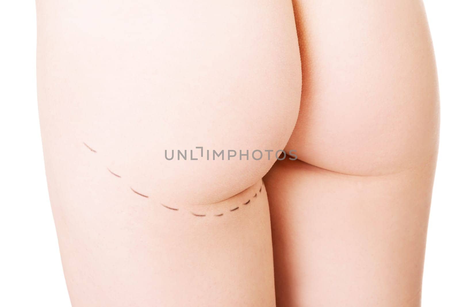 Woman's buttock prepared to plastic surgery , isolated on white