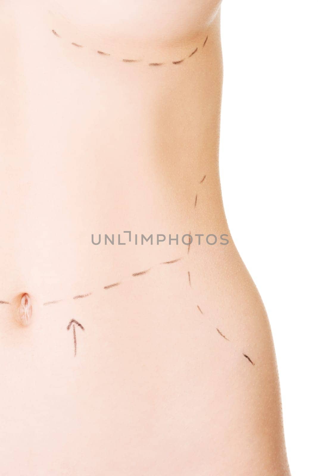 Woman belly marked out for cosmetic surgery. Isolated on white.