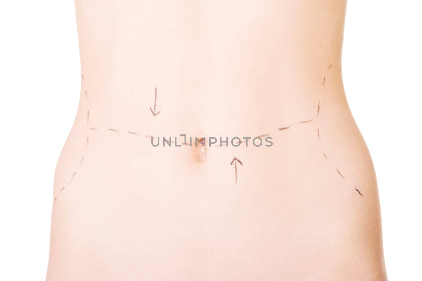 Woman belly marked out for cosmetic surgery. Isolated on white.