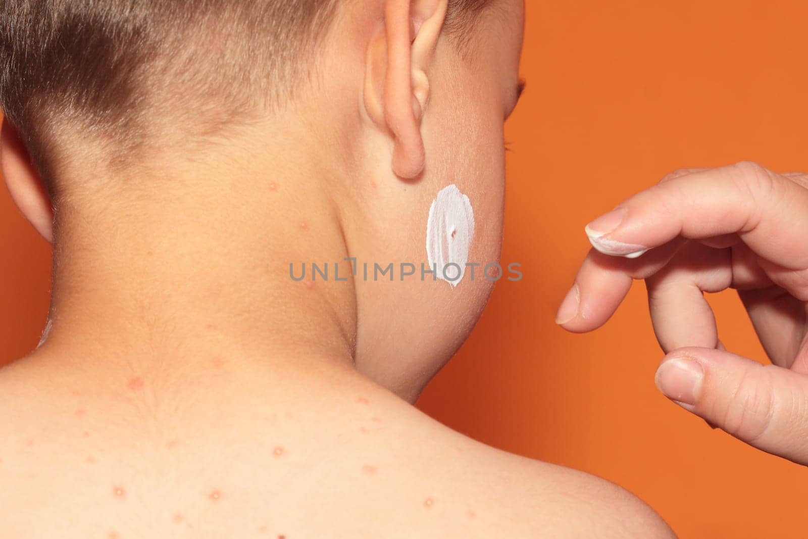 Baby boy with chicken pox rash