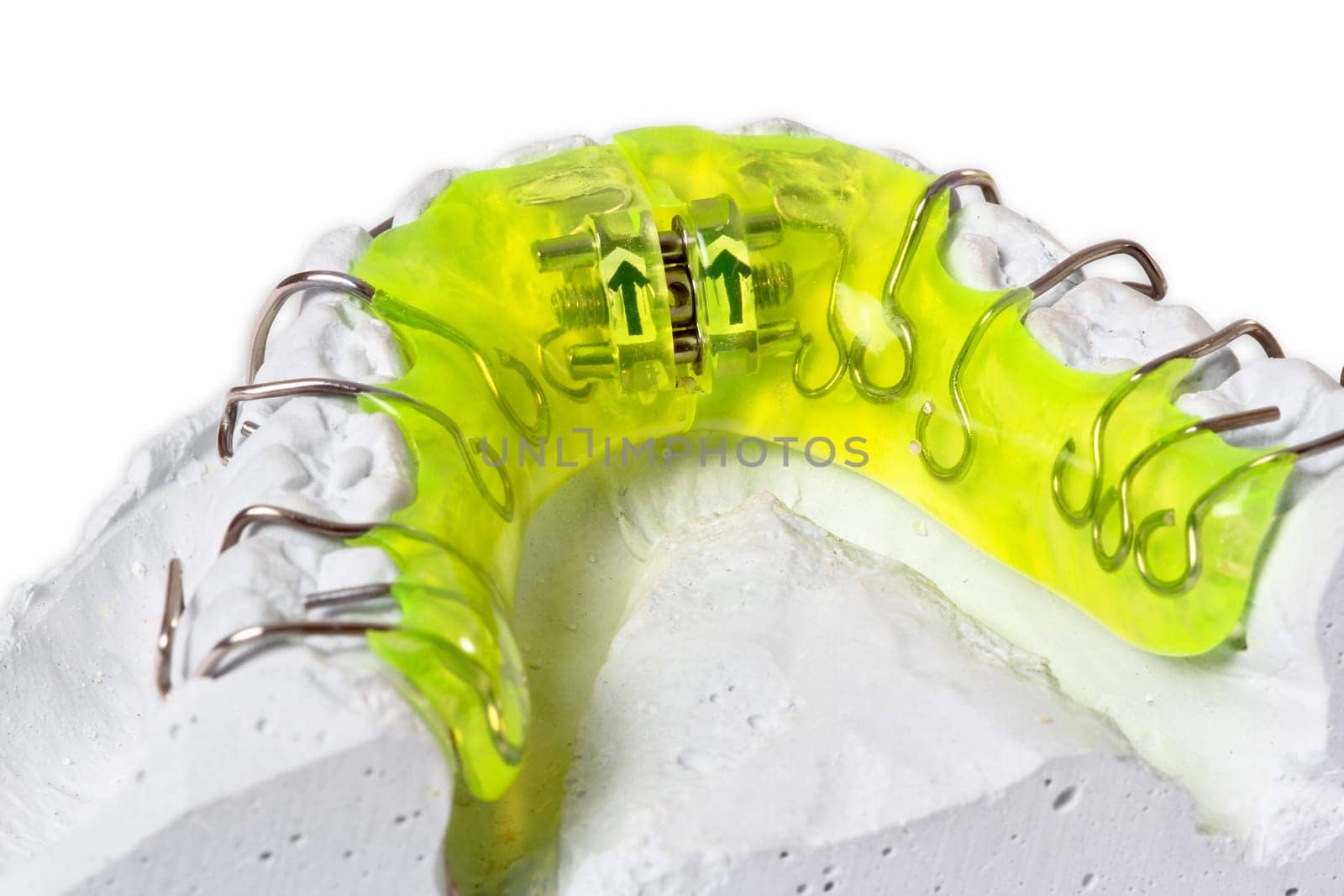 Plaster cast with braces