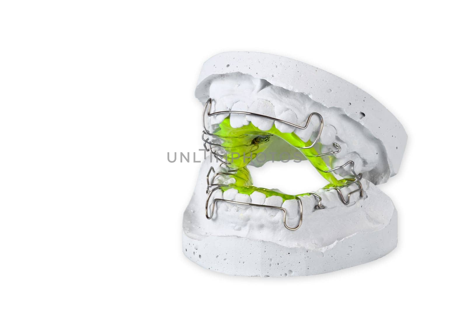 Plaster cast with loose braces