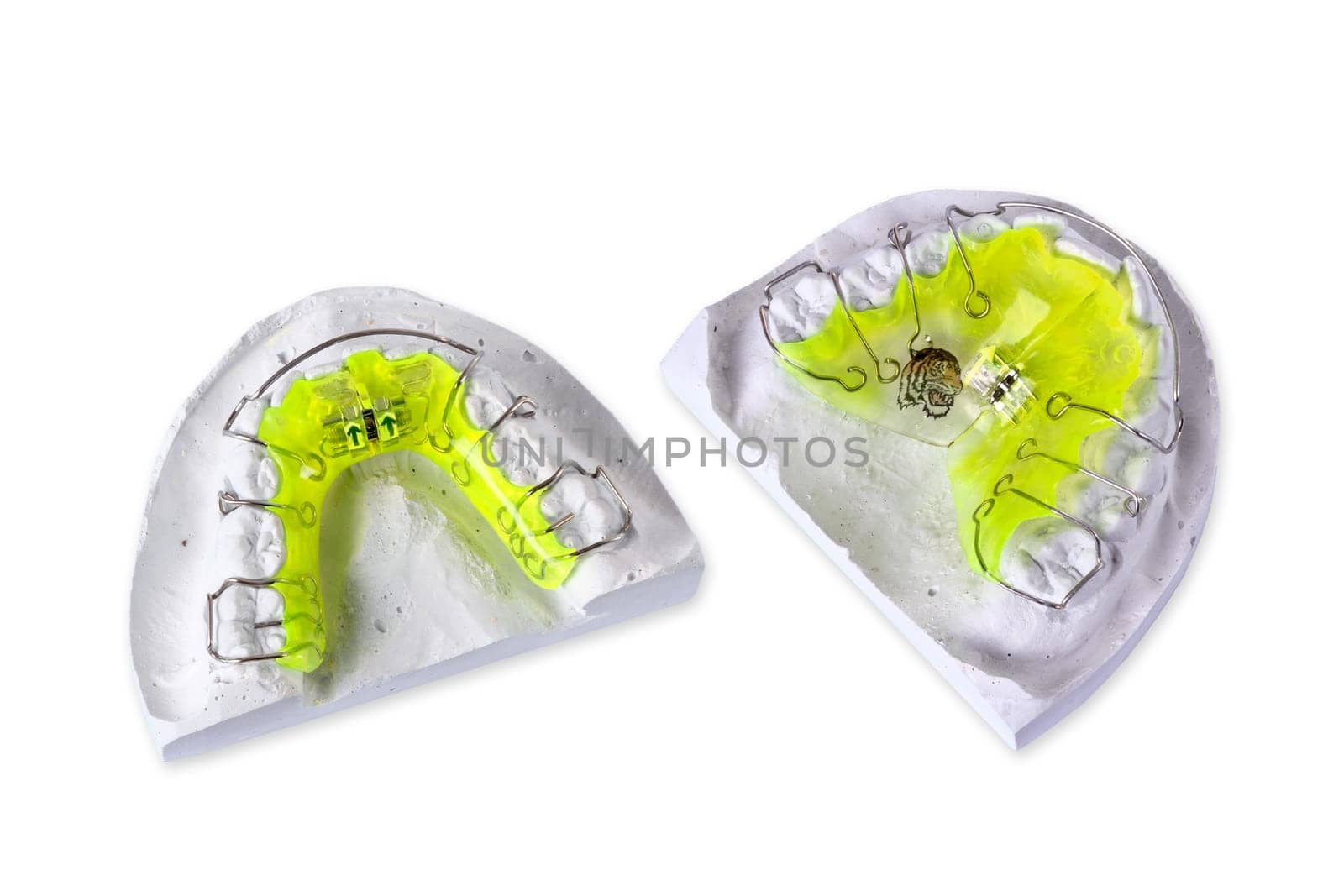 Upper and lower jaw,braces