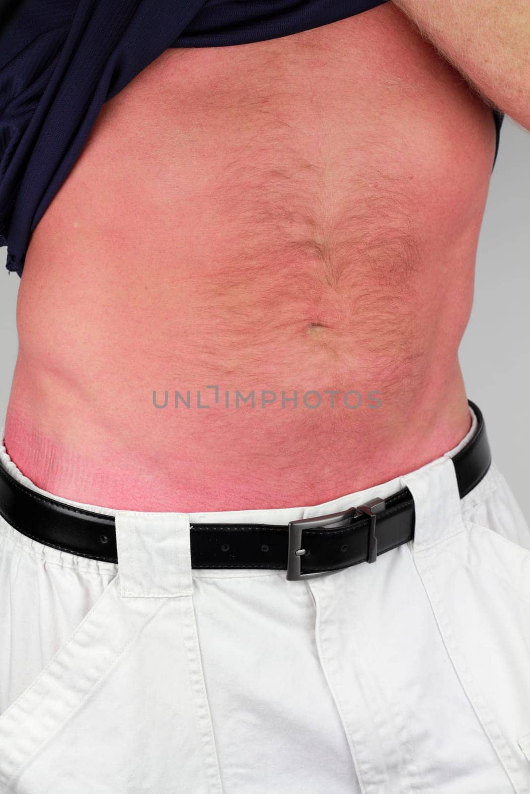Relaxed close up of red sun burned skin on a thin caucasian adult male stomach under navy blue color shirt and above ivory cargo short pants with a modern black belt sporting a brushed silver buckle..