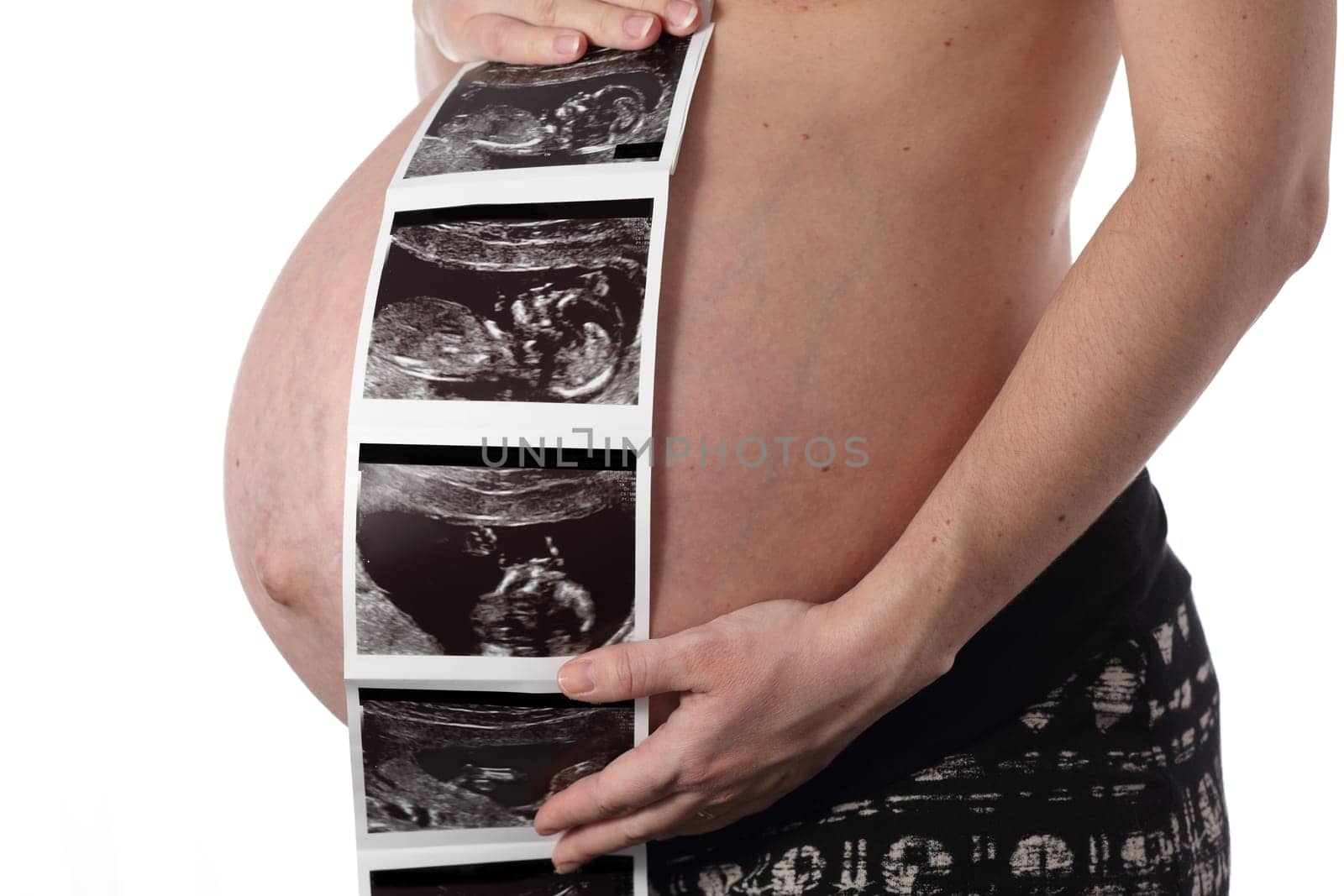 Details of a belly during pregnancy isolated on white background with sonogram.