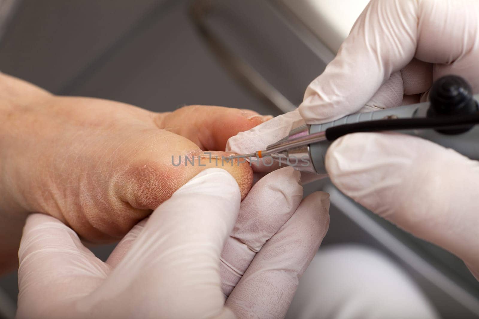 Machine toenail with grinding machine