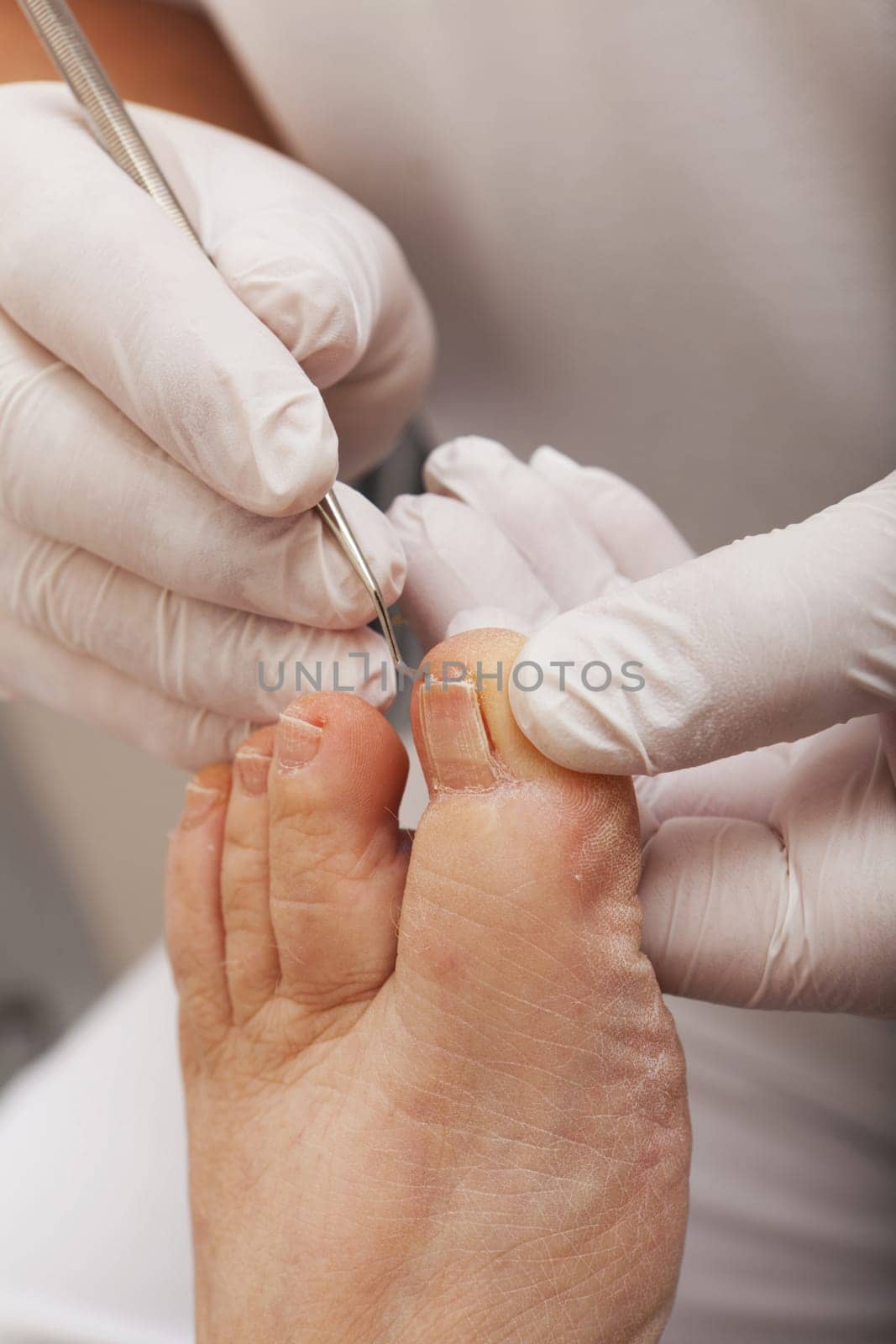 Foot care worker works with a tamponing hook