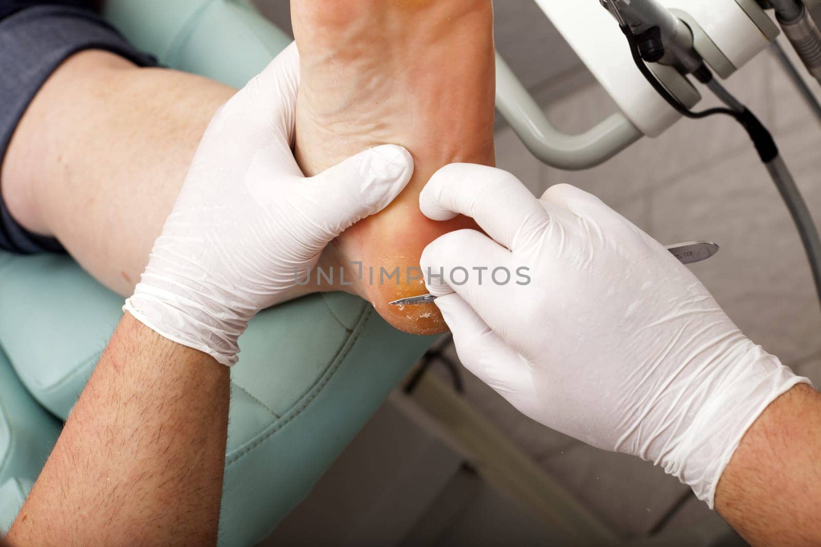 Remove the cornea with the scalpel