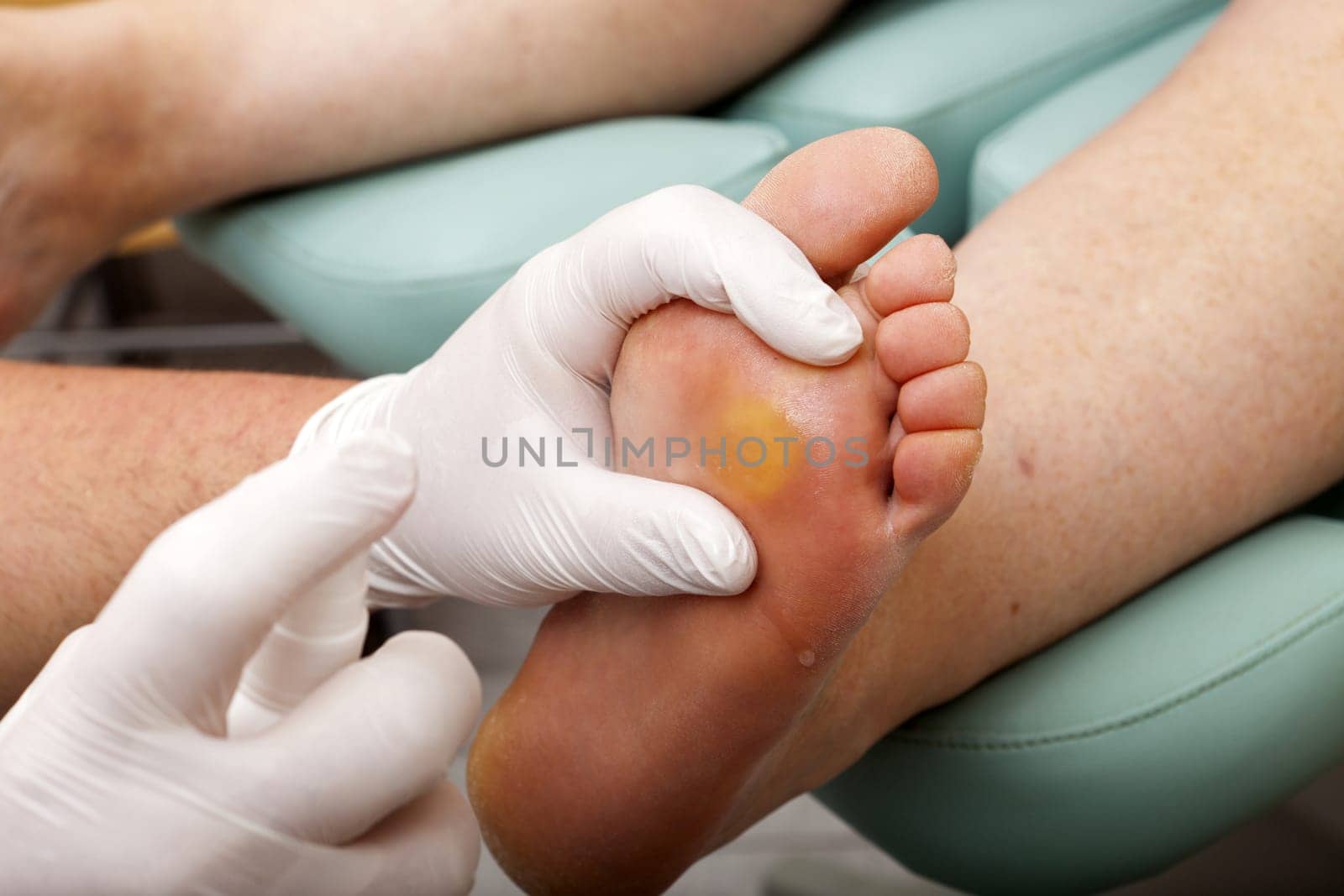 Foot care worker sprays foot sole with disinfectant