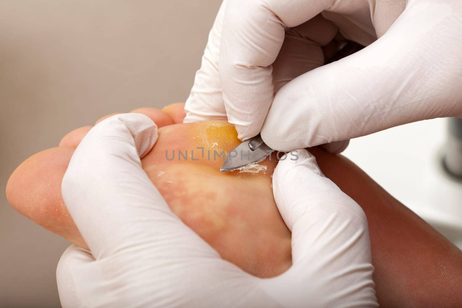 Foot care worker works wart with scalpel