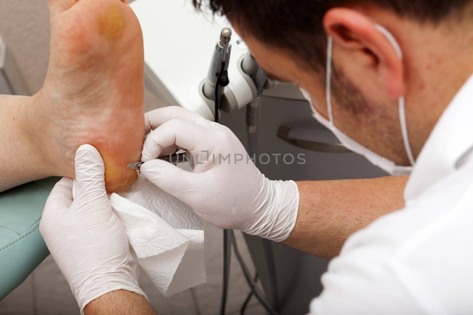 Foot care worker removes cornea on the sole of the foot