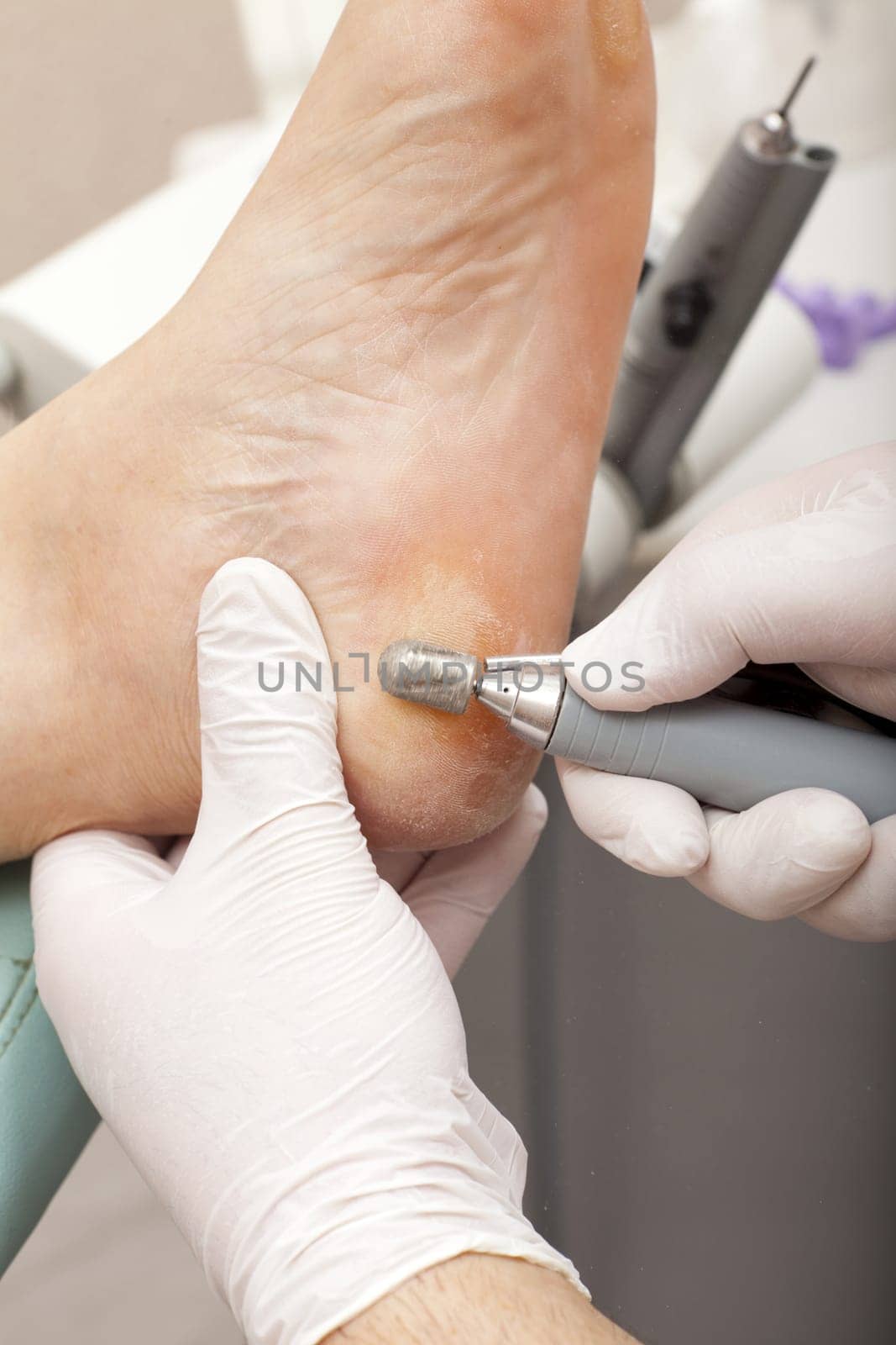Foot care era removed with grinding machine cornea