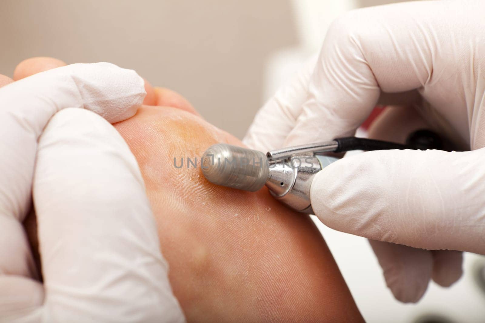 Remove skin from wart with abrasive attachment